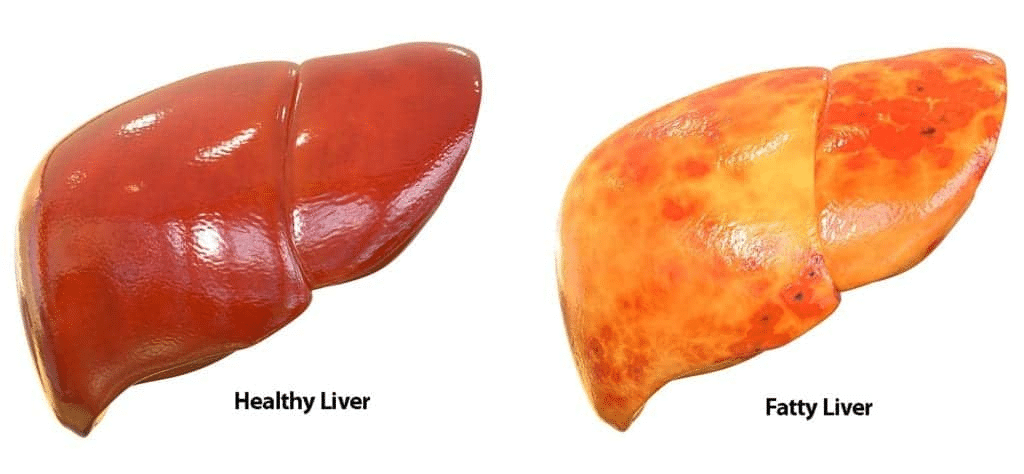 fatty liver ayurvedic treatment